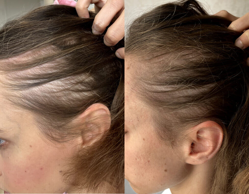 Crown & Bloom™ - Follicle Stimulating + DHT Blocking Botanical Hair Growth Serum